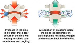 traction therapy