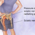 sciatic pain shakopee