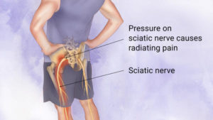 sciatic pain shakopee